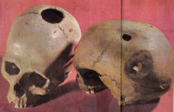 two Paleolithic skulls reveal healed and unhealed trephined openings